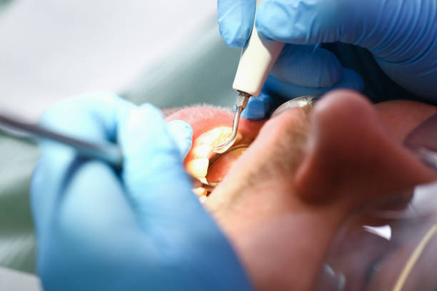 Best Emergency Wisdom Teeth Removal in Montello, WI