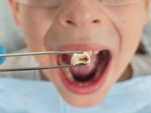 Best Emergency Treatment for Toothache in Montello, WI